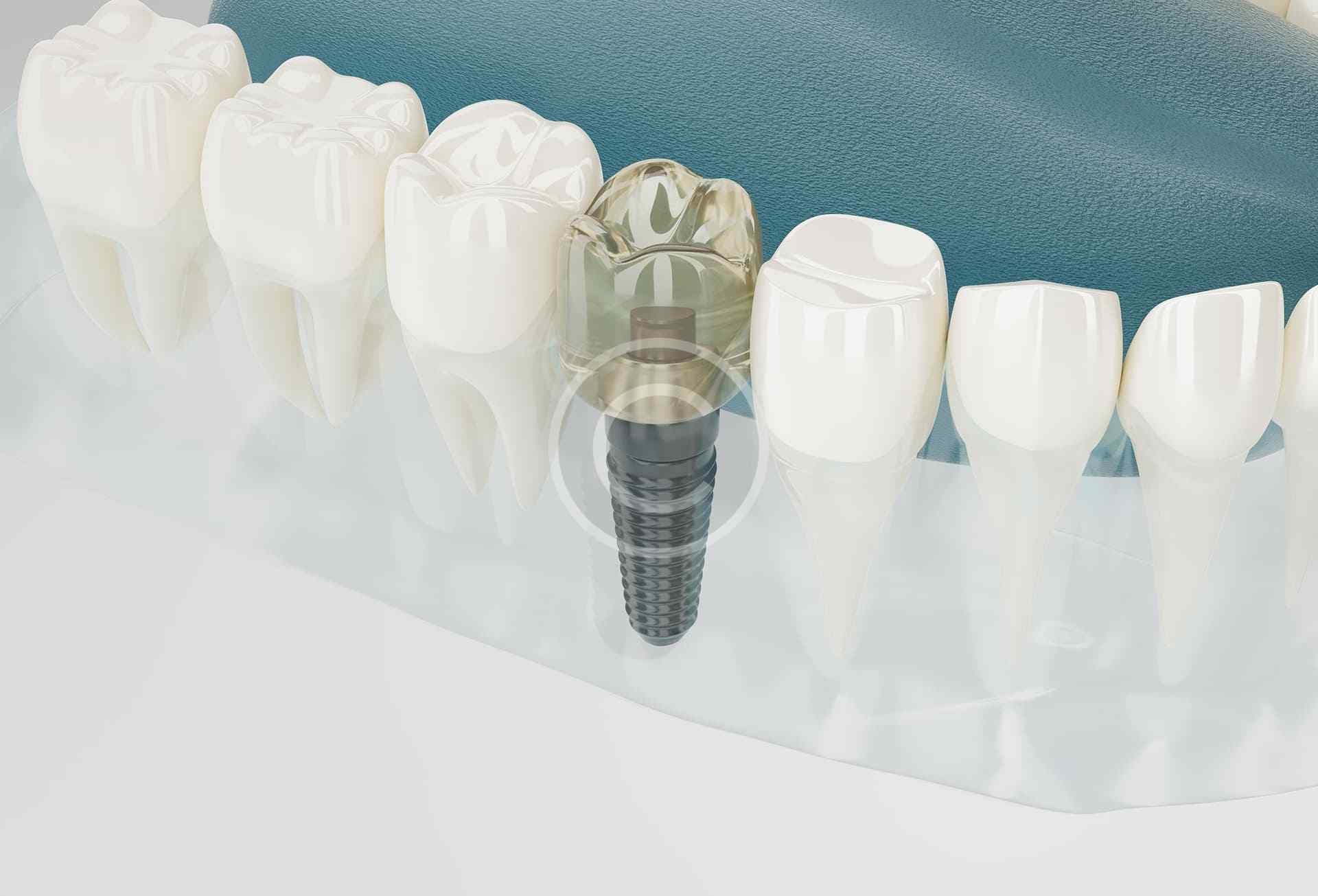 Tooth implant